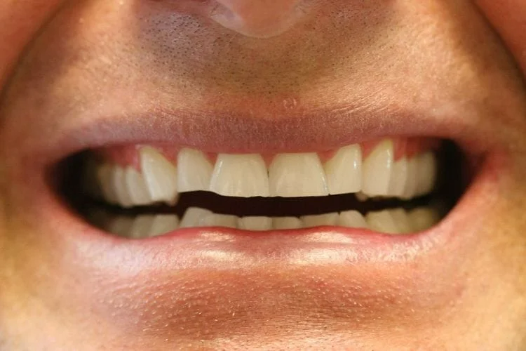 Close-up of a person's open mouth with white teeth and visible gums.