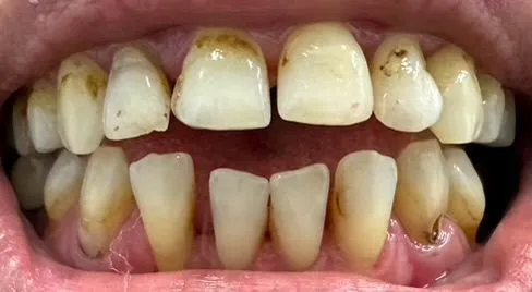 Close-up view of teeth with discoloration and signs of decay. Yellowish hue with some brown spots.