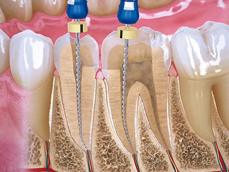 Un primer plano de los dientes de una persona con instrumentos dentales en ellos.