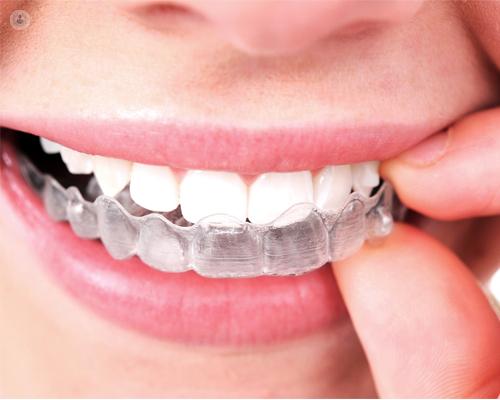 Un primer plano de la boca de una persona con un aparato transparente en los dientes.