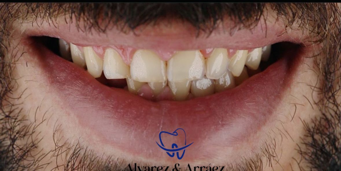 Un primer plano de la boca de un hombre con barba y dientes.