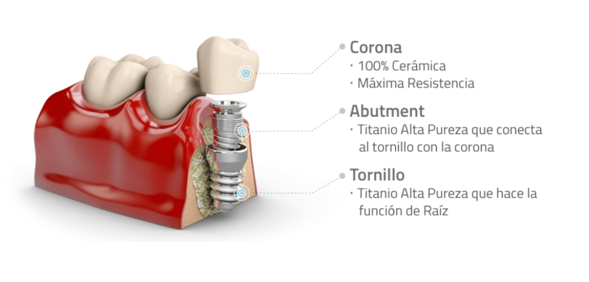 Un modelo de un implante dental con una corona sobre él.
