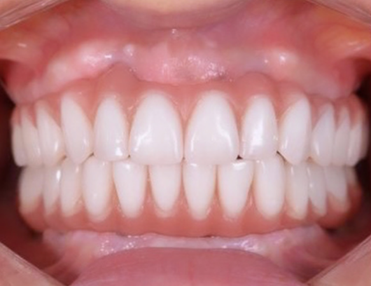 Un primer plano de los dientes de una persona con dientes blancos.