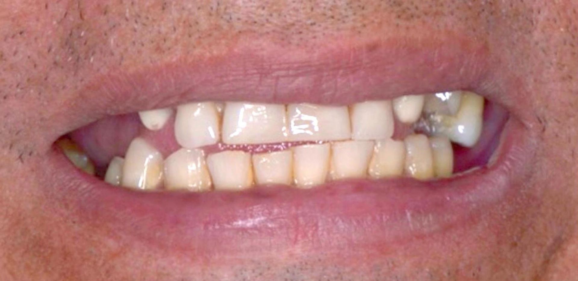 Un primer plano de la boca de un hombre sin dientes.