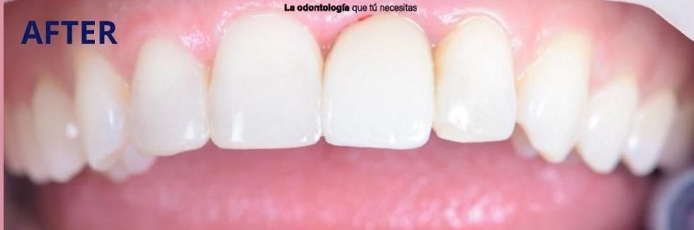 Un primer plano de los dientes de una persona con las palabras 