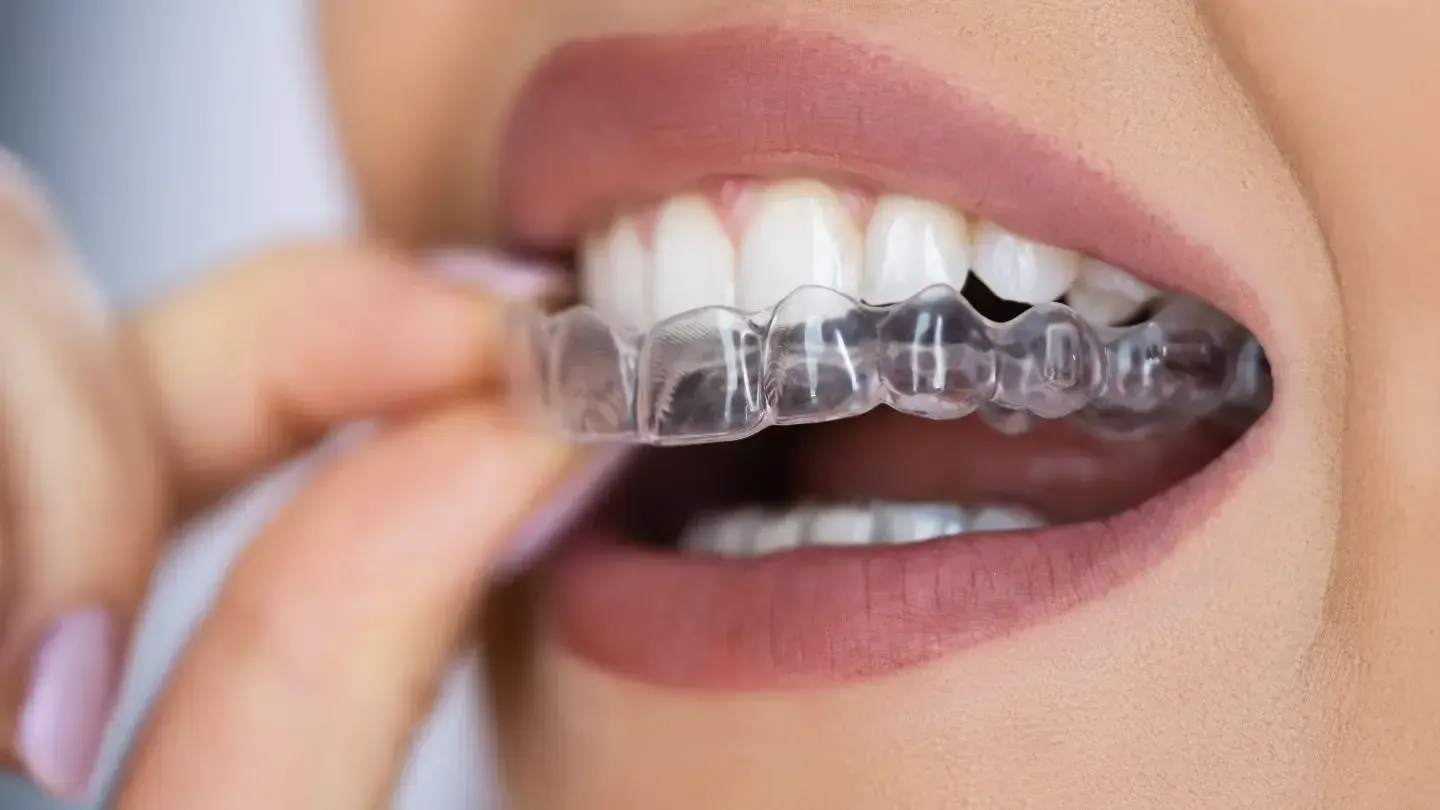 Person inserting clear aligner over teeth.