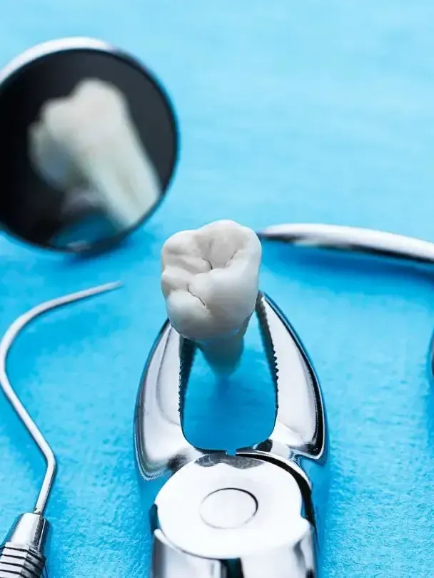 Extracted tooth held in dental forceps, with mirror and tools on a blue surface.
