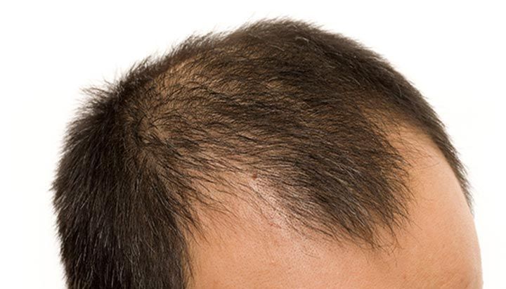 Balding man with thinning dark hair on the top of his head.