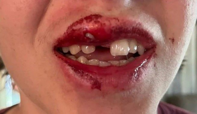 Close-up of a person with a bloody mouth and missing front tooth, likely from an injury.