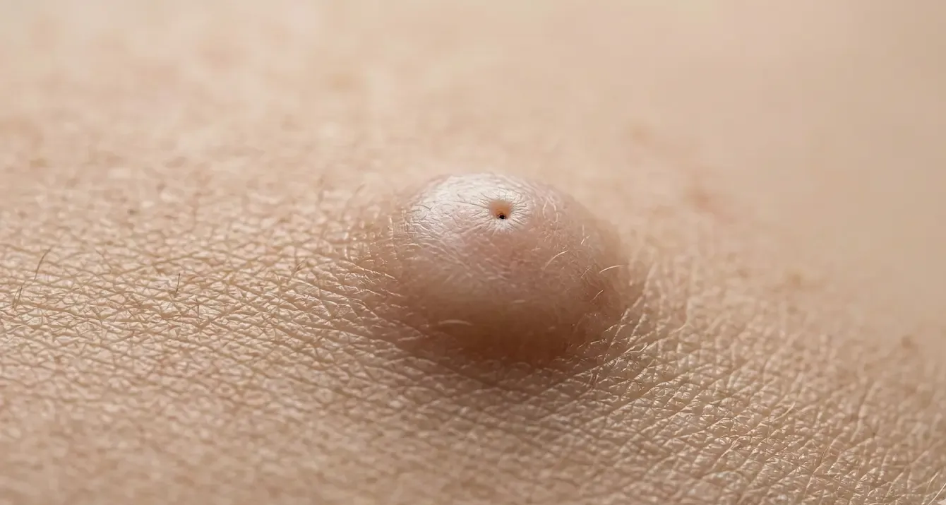 Close-up of a small raised skin bump with a tiny central opening on a light-colored surface