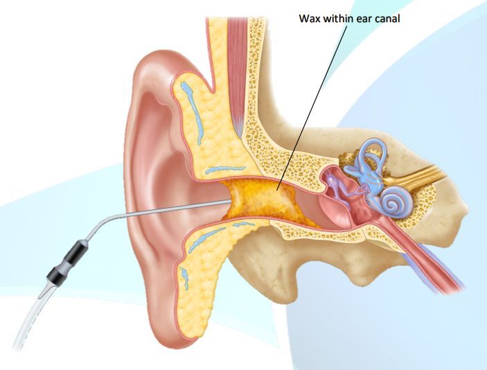 Cross-section of an ear showing wax buildup and a medical device removing it.