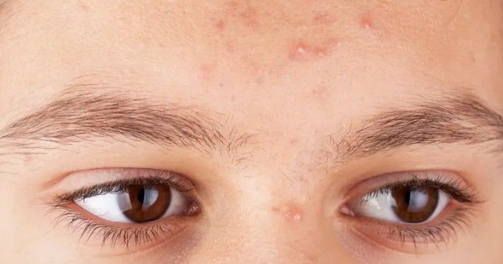 Close-up of a person's eyes and forehead with visible acne. They have brown eyes and arched eyebrows.