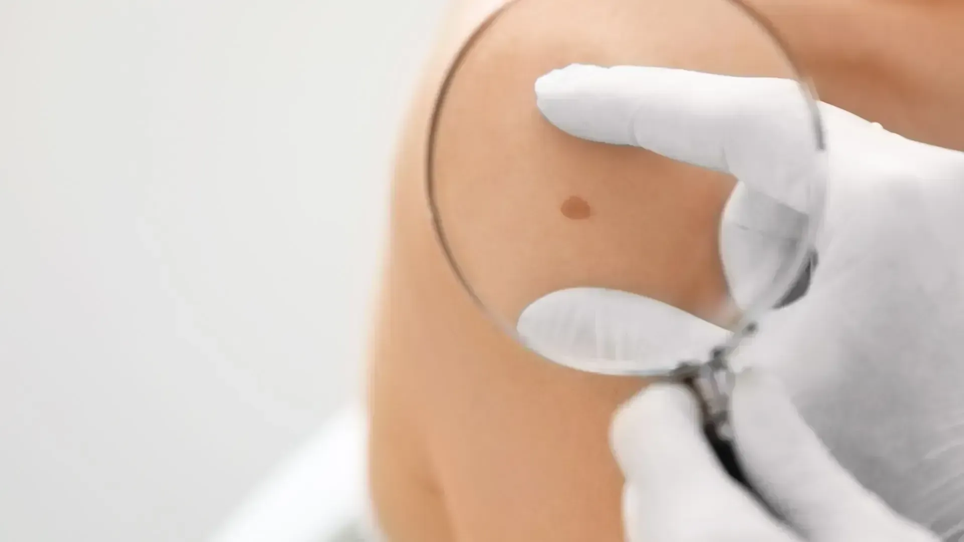 A gloved hand uses a magnifying glass to examine a small, brown mole on a person's skin.