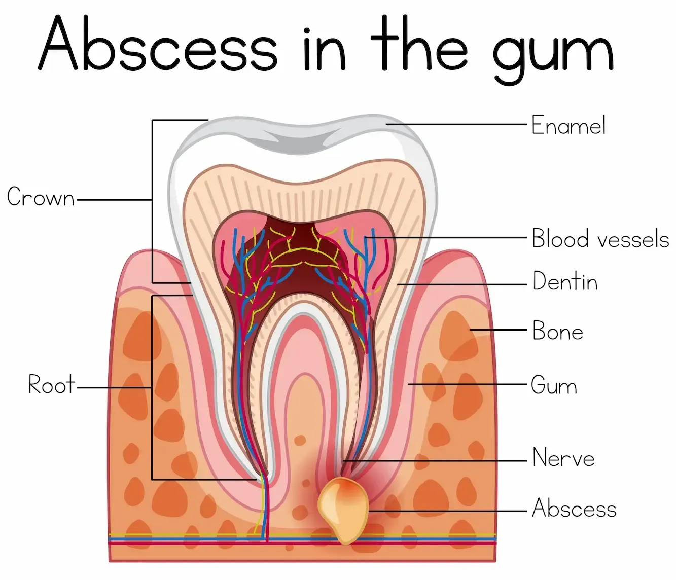 Cross-section of tooth with abscess in gum. Shows enamel, crown, root, blood vessels, nerve, and bone, with a visible infection.