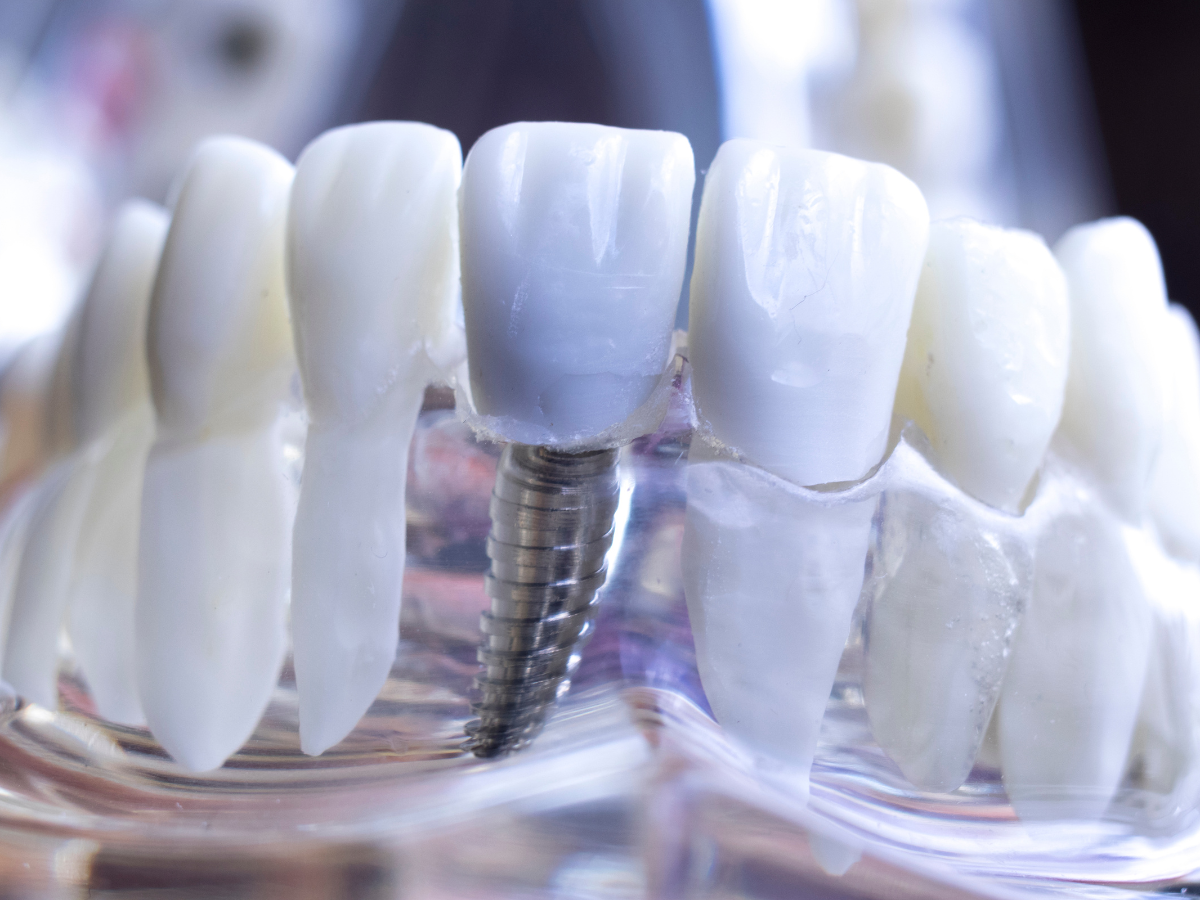 Dental implants treatment options comparison at Westmount Dental Waterloo