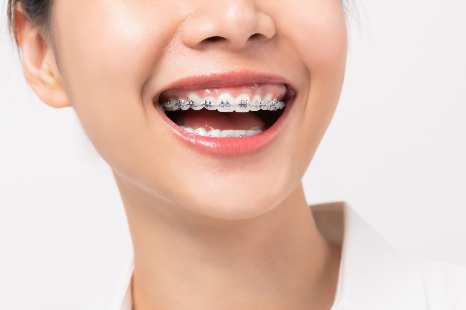 Close-up of a person smiling, showing straight, white teeth and lips.