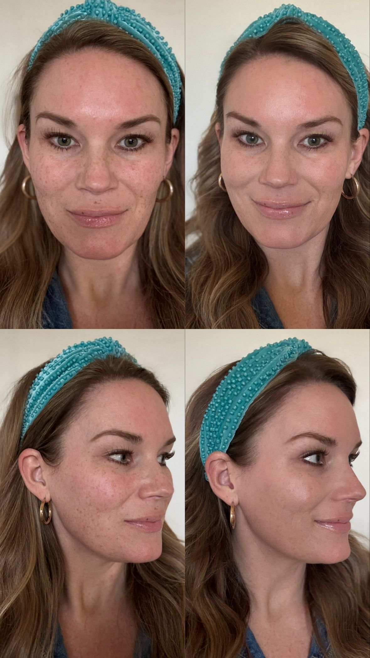 Before and after comparison of a person's facial skin texture, showing improved clarity and smoothness after treatment.