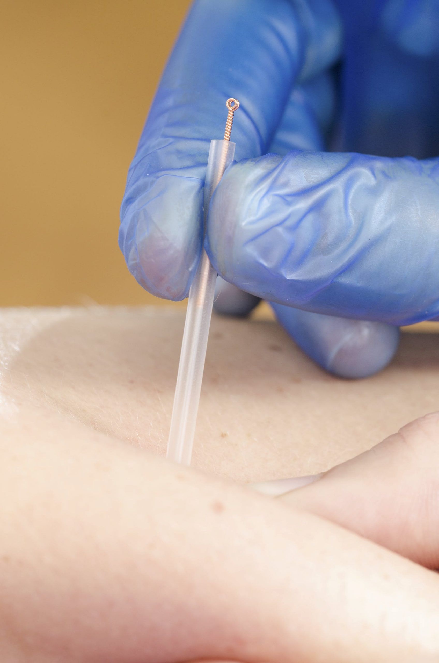 Dry needling treatment