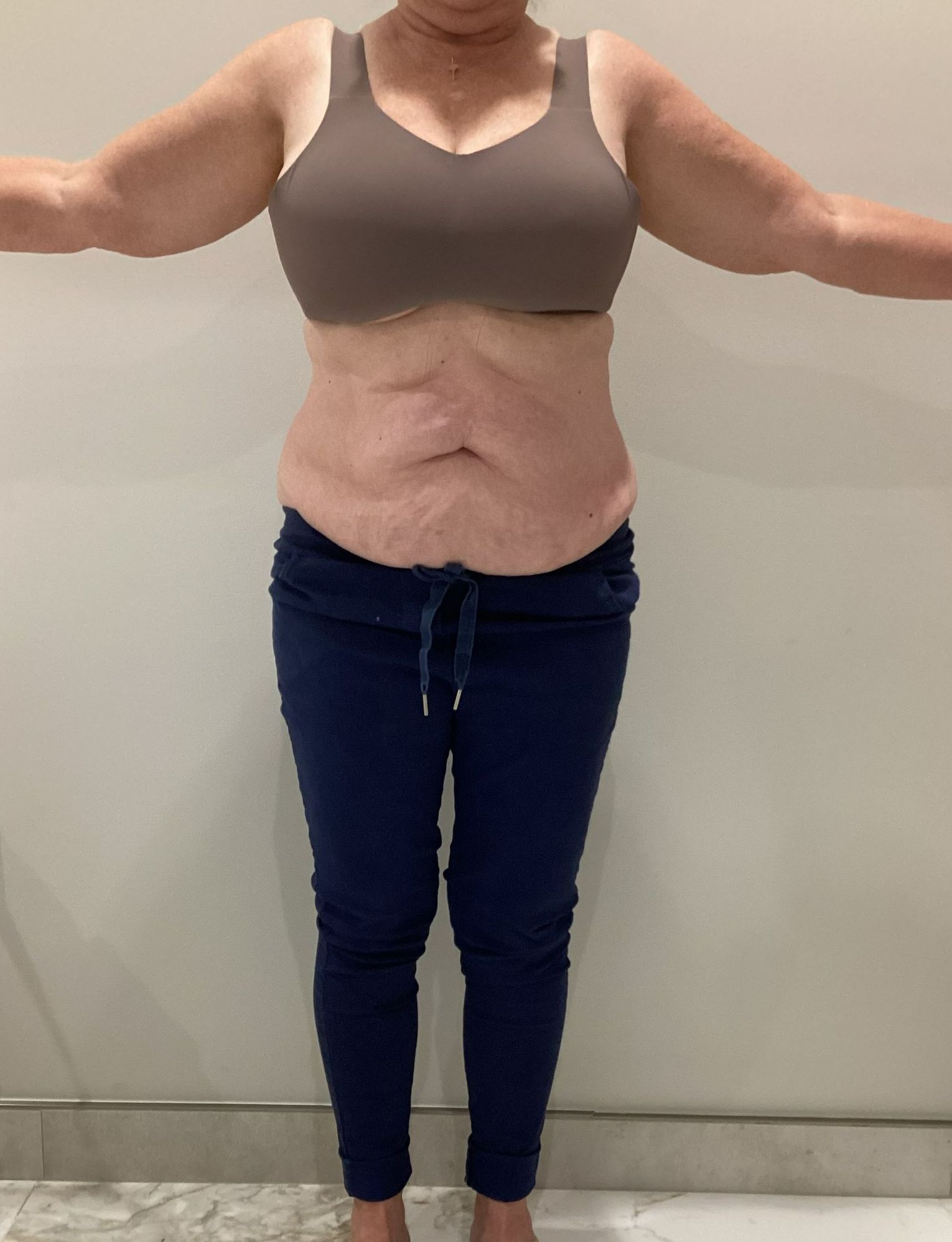Frontal view of a woman's torso after going to The Body Lab Med Spa for non-surgical fat reduction treatment.
