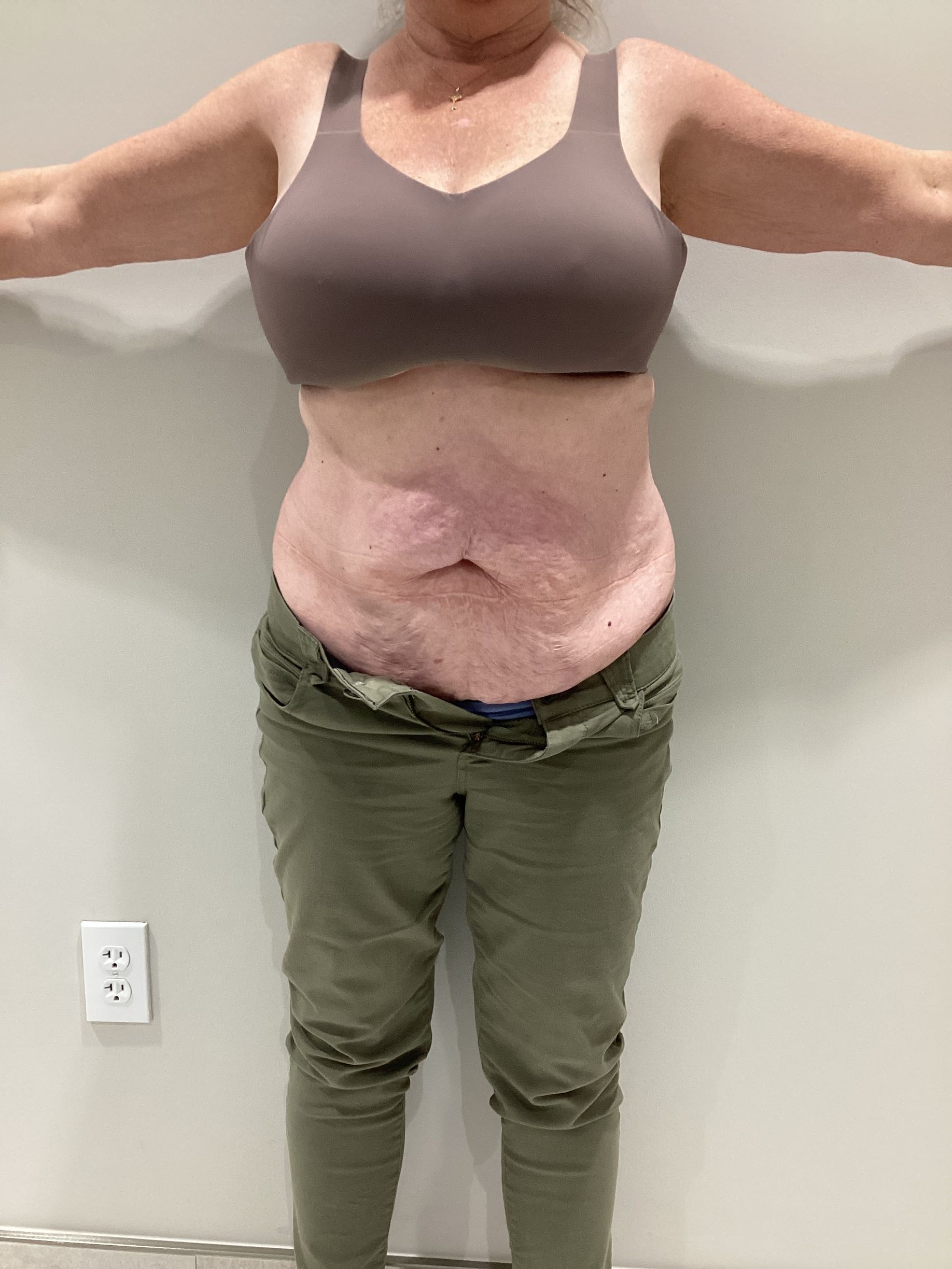 Frontal view of a woman's torso before going through non-surgical fat reduction treatment.