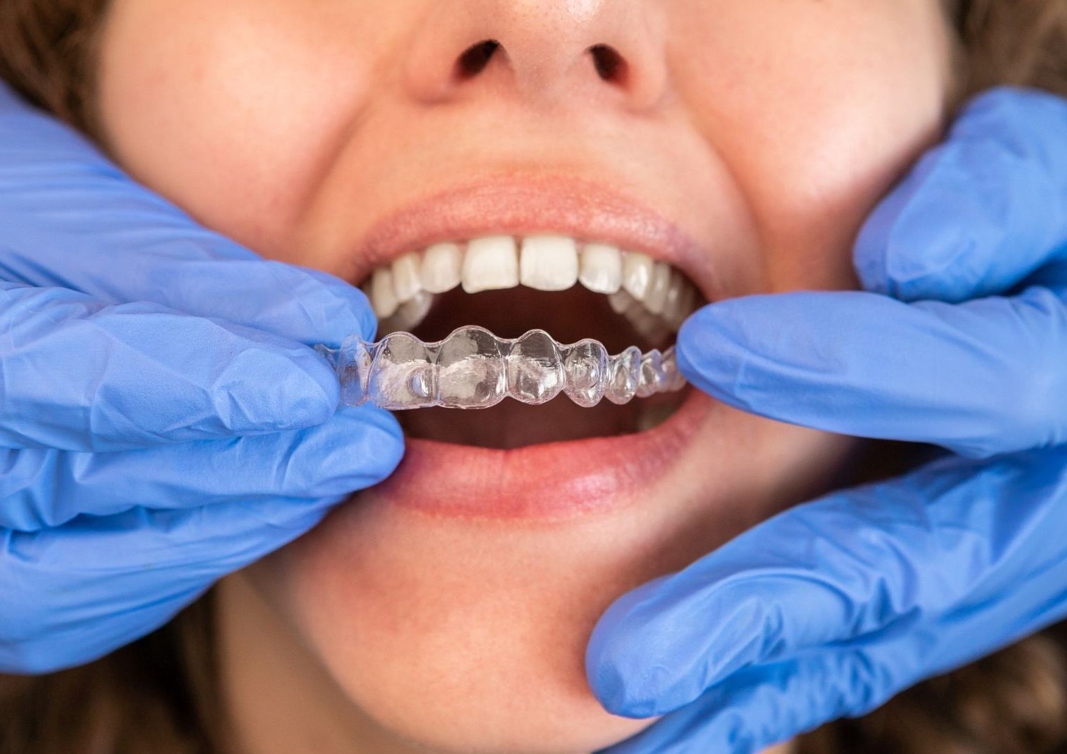 Una donna si sta facendo raddrizzare i denti da un dentista.