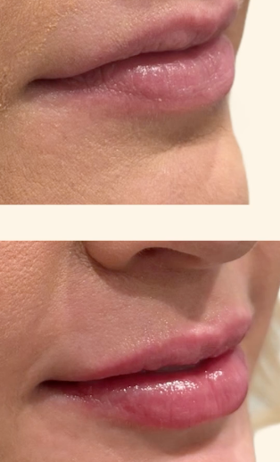 Before and after Lip Filler in Eagle Mountain, Utah