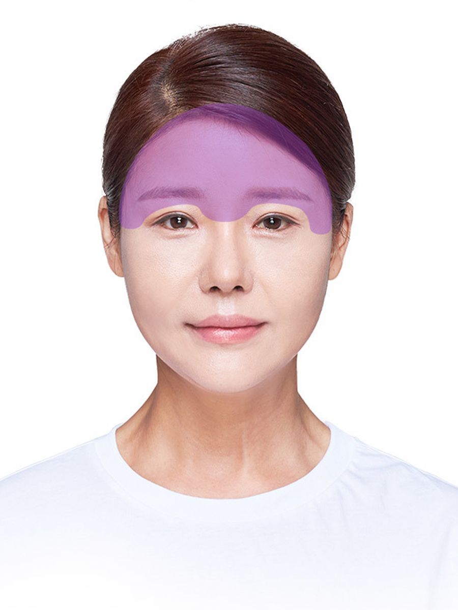 Woman's face with purple shaded forehead and brow area, likely indicating a cosmetic procedure area.