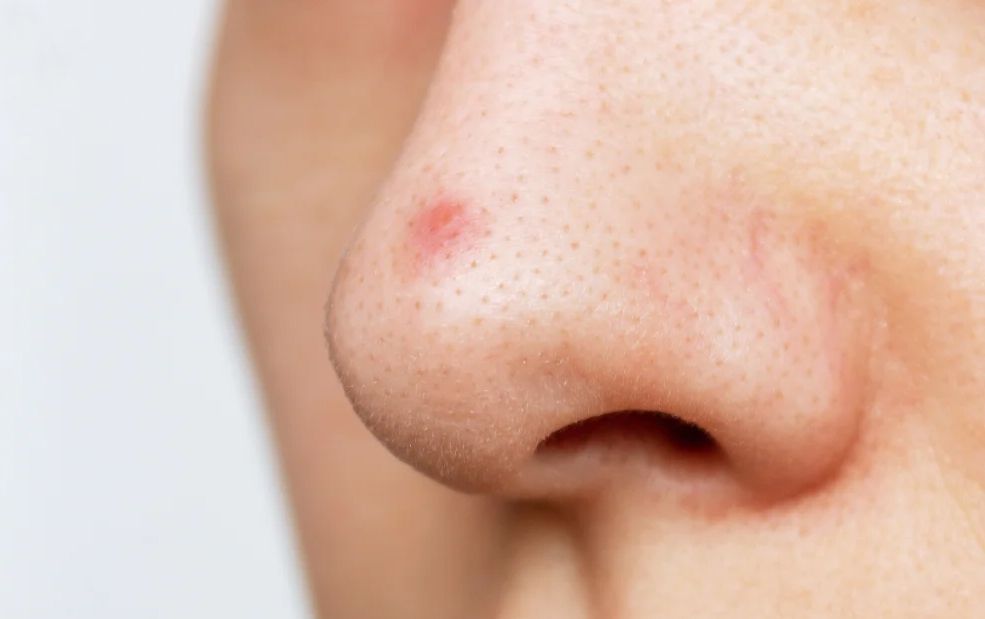 Close-up of a nose with a red, inflamed blemish on the skin.
