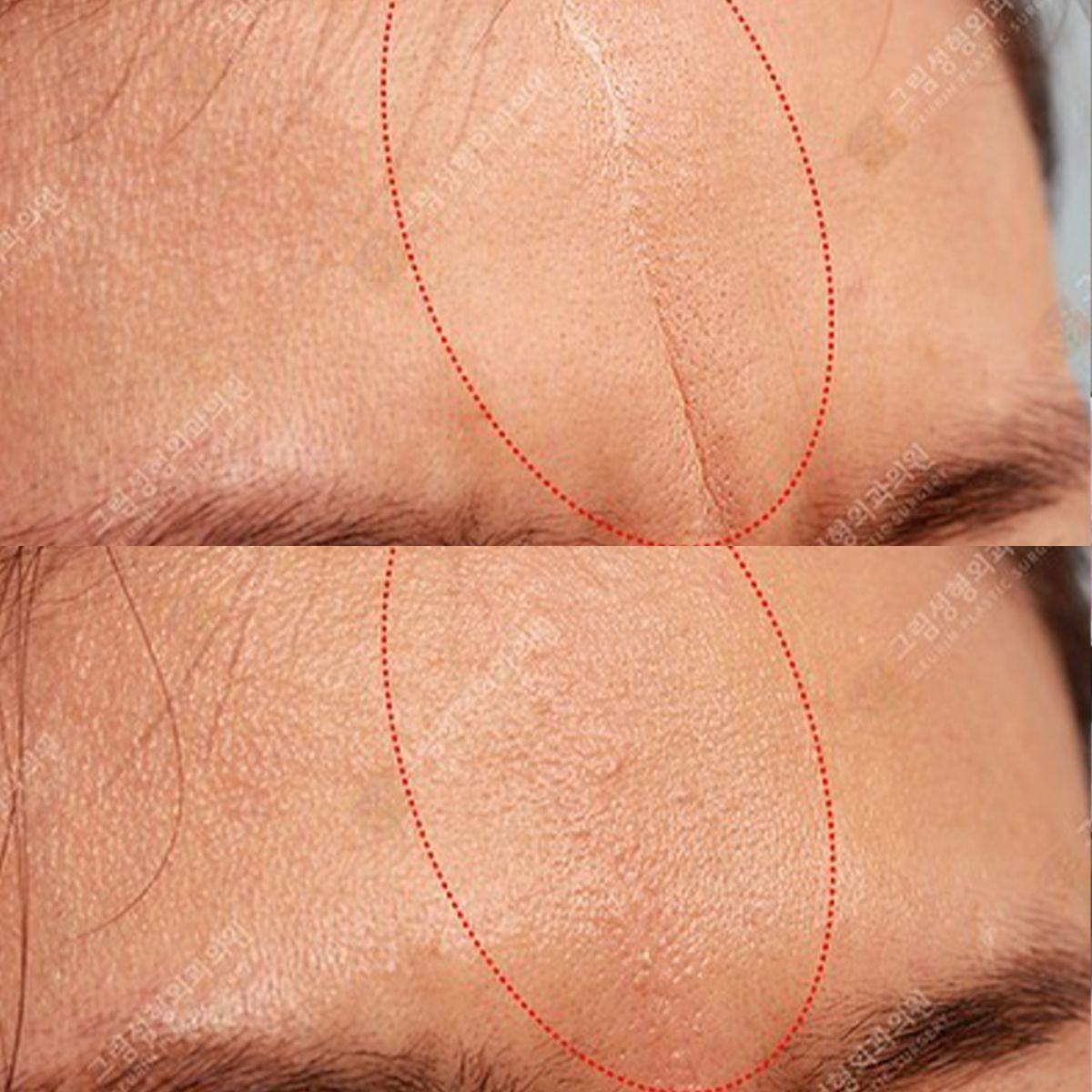 Forehead before/after showing scar reduction. Top image: prominent scar. Bottom image: scar less visible.