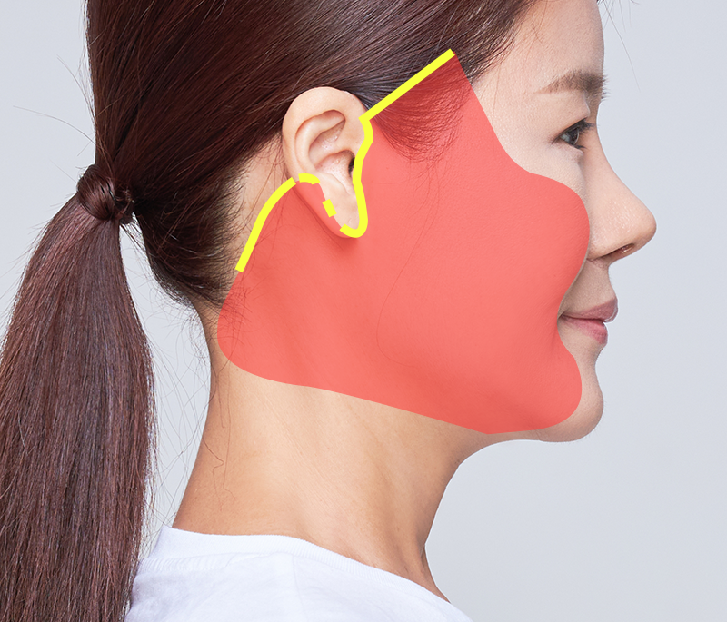 Profile view of a face, highlighted in red with a yellow outline near the ear, possibly for cosmetic surgery.