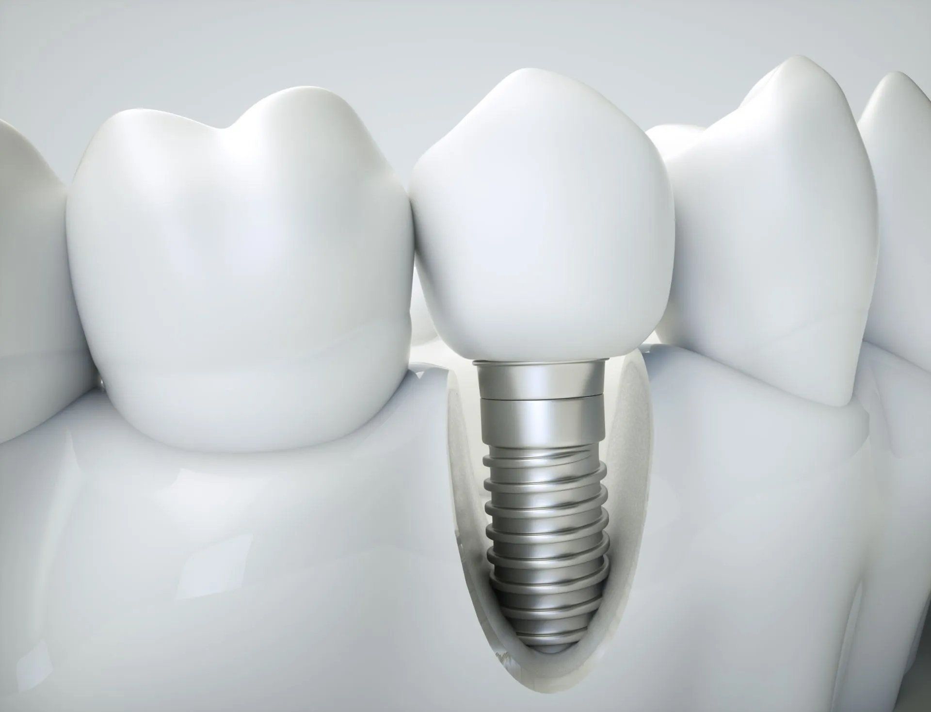 Dental Implant — Amherst, OH — Gregory Sy, DDS