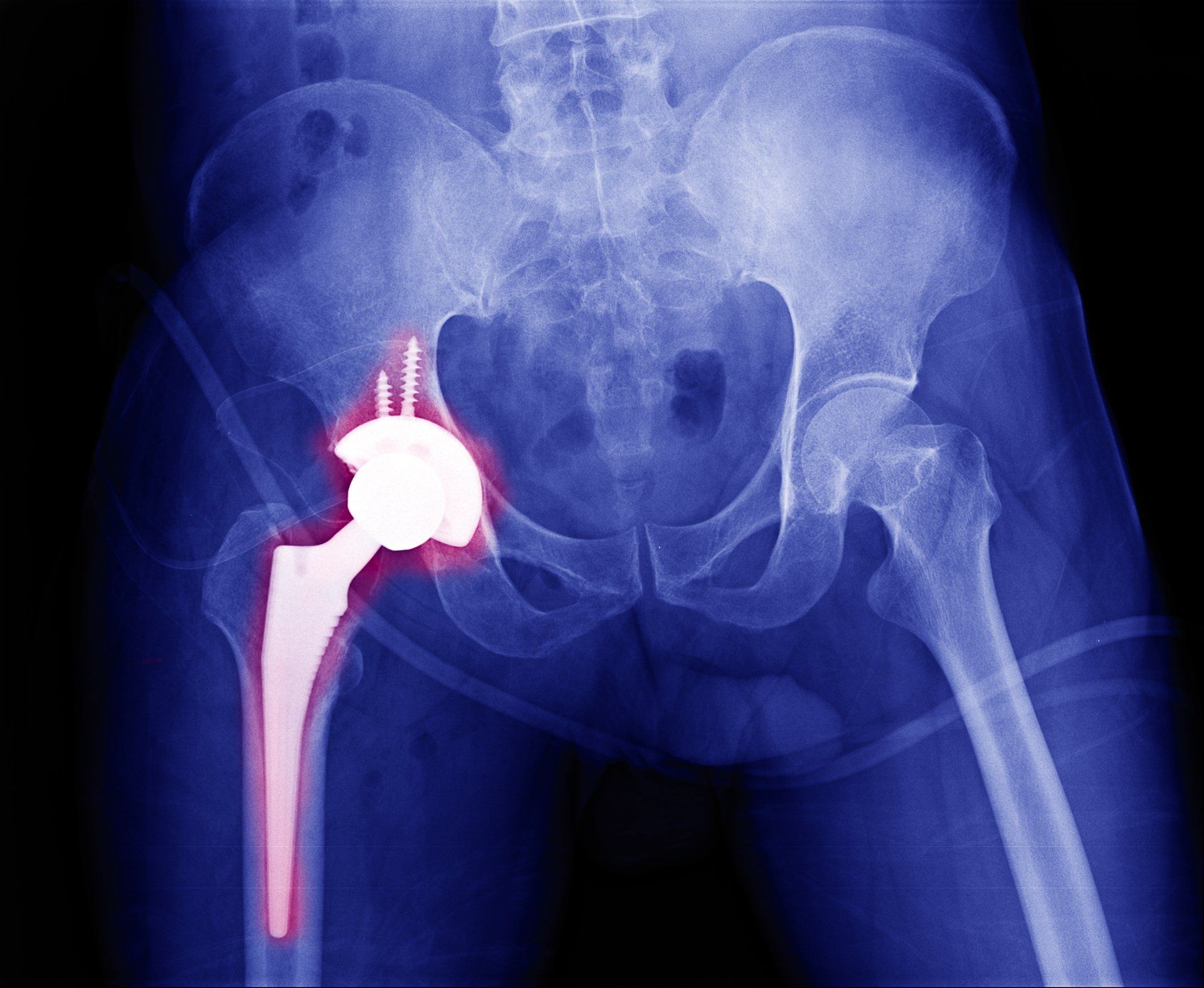 Hip X-Ray — Webster, TX — Ian J Reynolds MD F.A.A.O.S.