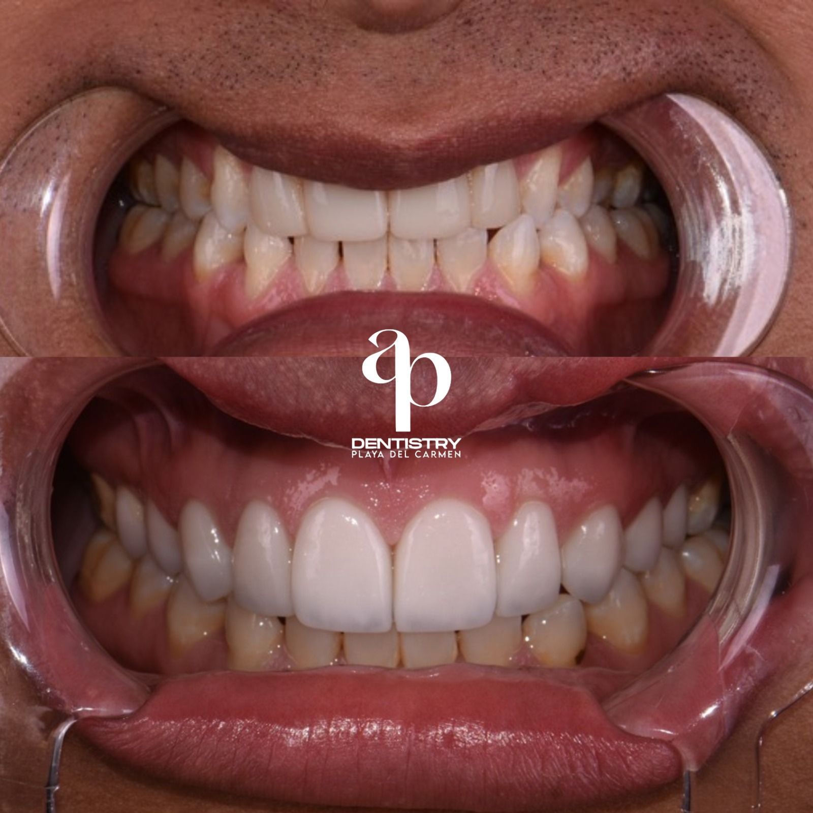 Veneers in Mexico