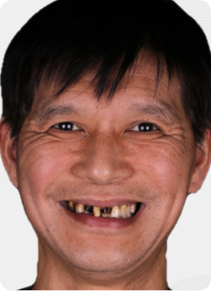 Smiling person with dark hair, visible missing teeth, and wrinkled skin.