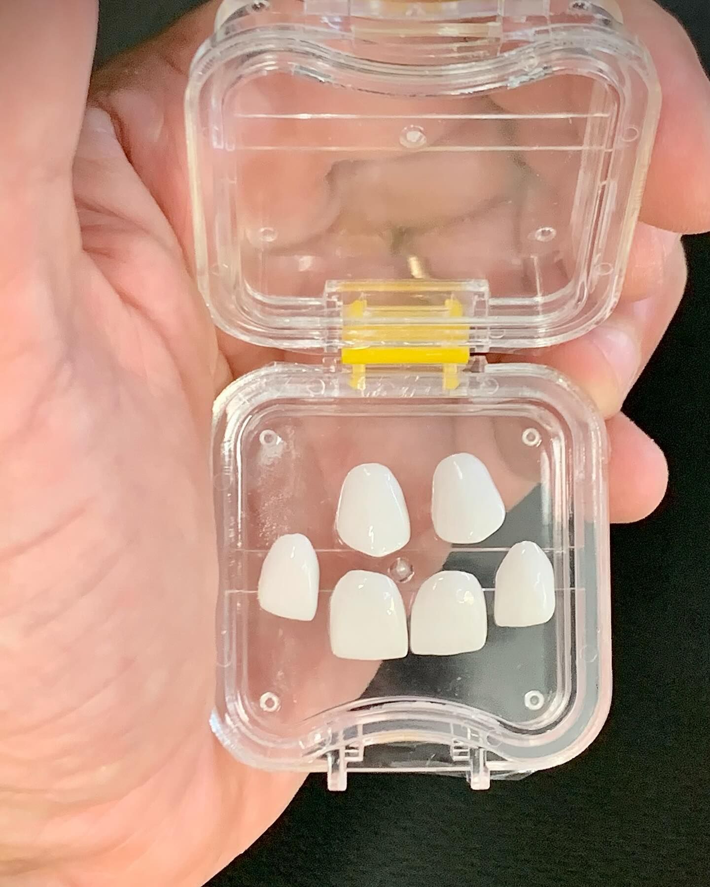 Six white dental veneers in a clear plastic case— AB Esthetic Dental Laboratory in Robina, QLD