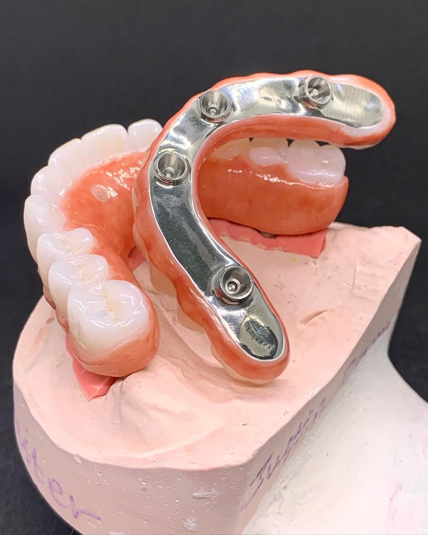 Dental implant model: dentures with metal bar attached, mounted on a pink plaster mold— AB Esthetic Dental Laboratory in Robina, QLD