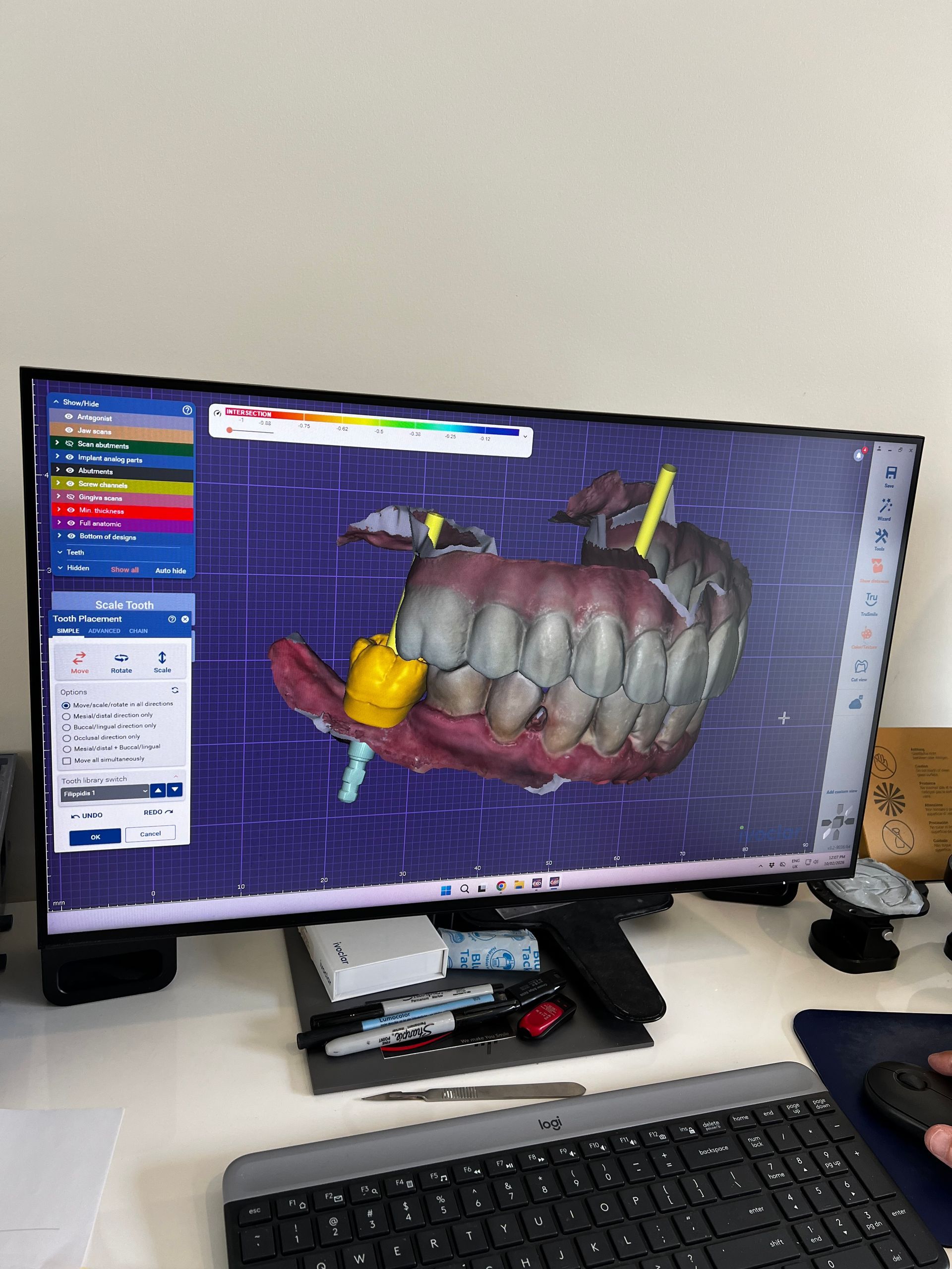 A Dental Model on a Computer — AB Esthetic Dental Laboratory in Robina, QLD