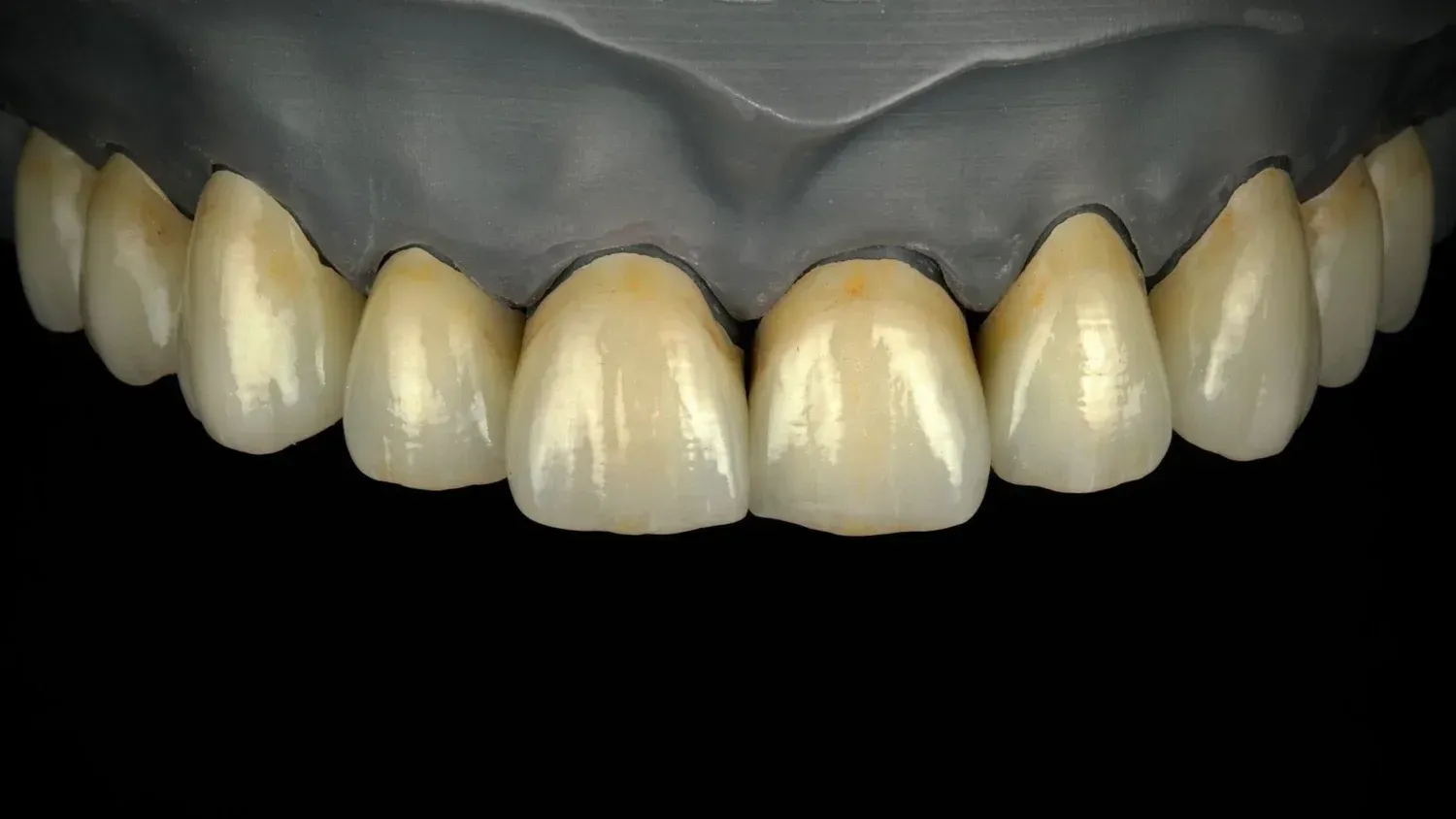Dental model displaying a row of artificial, light-colored teeth. — AB Esthetic Dental Laboratory in Robina, QLD