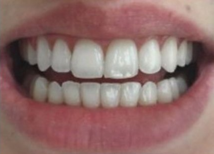 Close-up of a person's mouth with a clear view of white teeth, slightly parted lips.
