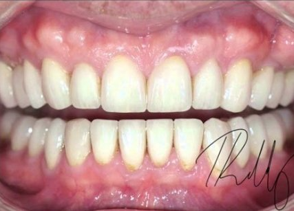 Close-up of a person's teeth. Bright white teeth with slight yellowing at the bottom. The gums are pink.