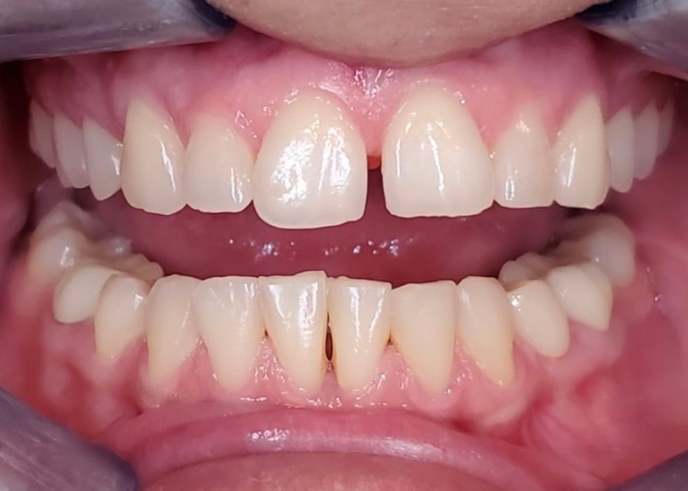 Close-up of a person's teeth, showing a gap between the front teeth, with visible gums and tongue.