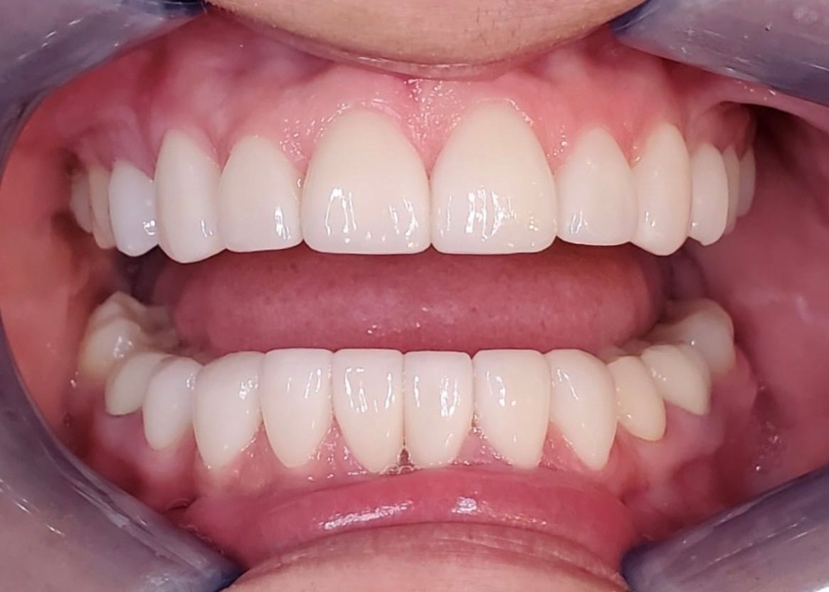Mouth with bright, white teeth, open, showing upper and lower rows, pink gums and tongue visible.