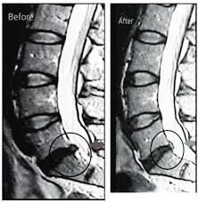 MRI scans of lumbar spine before and after a procedure, showing changes to the circled area of concern.