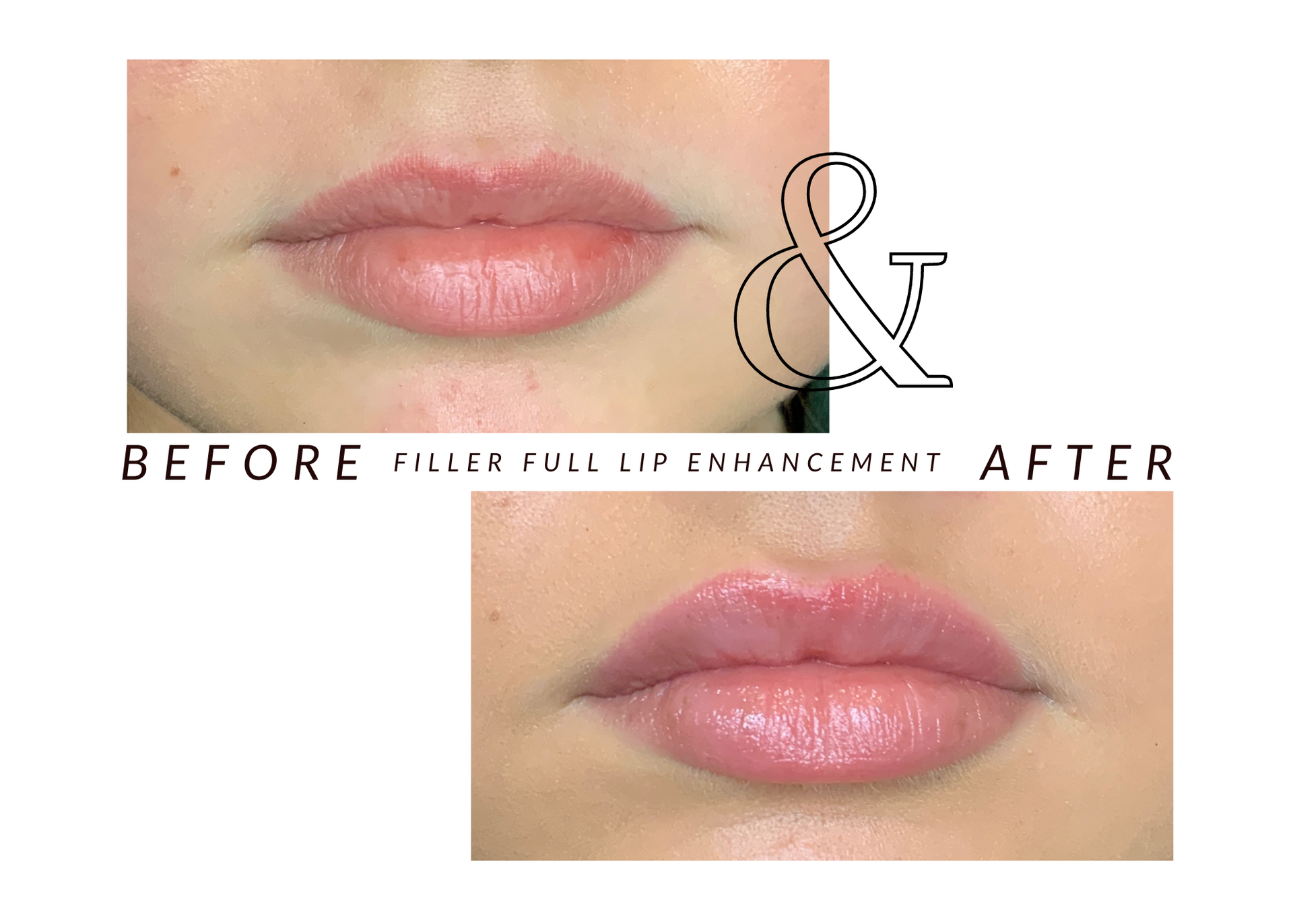 A picture of a woman 's lips before and after filler full lip enlargement