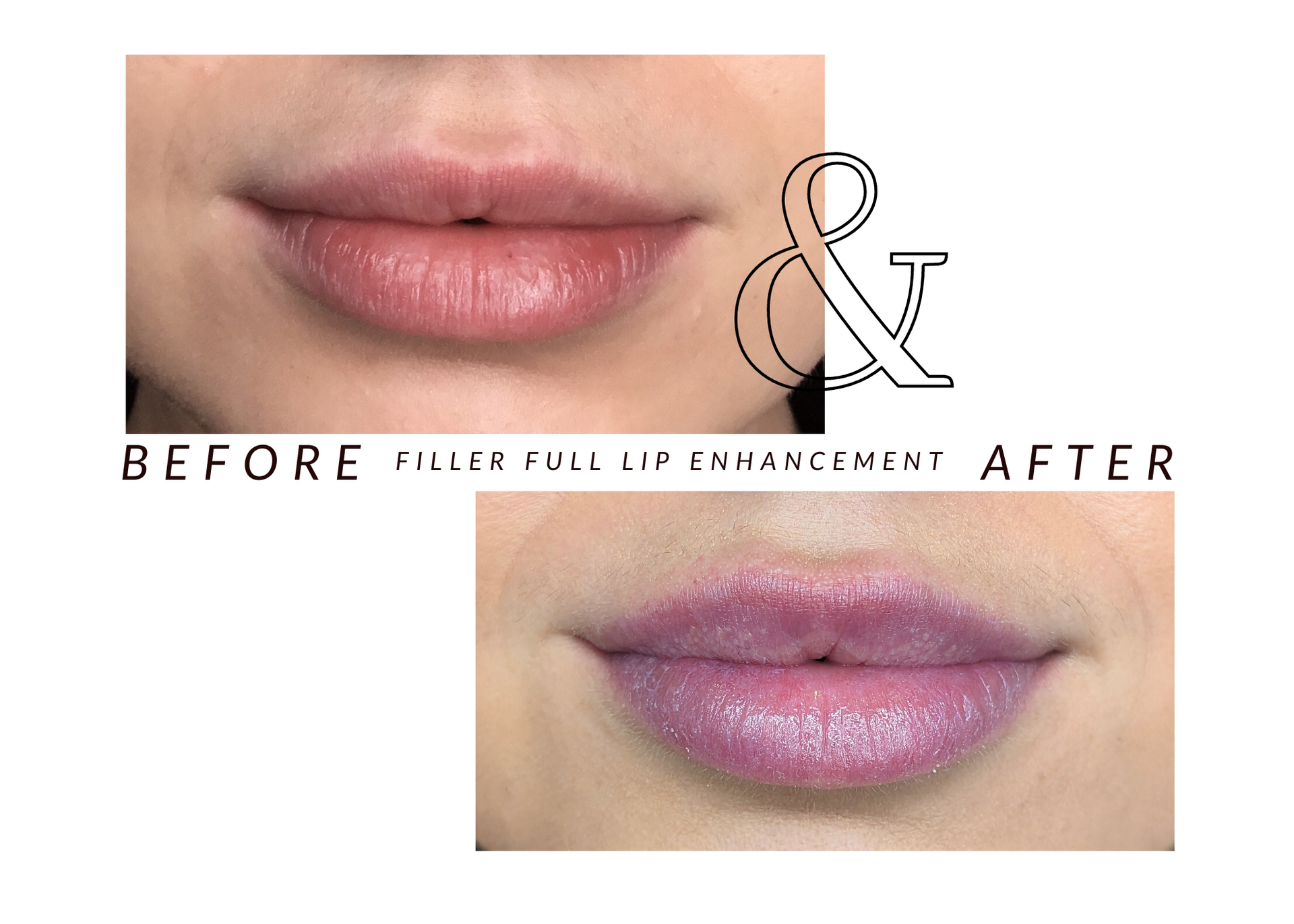 A picture of a woman 's lips before and after filler full lip enlargement