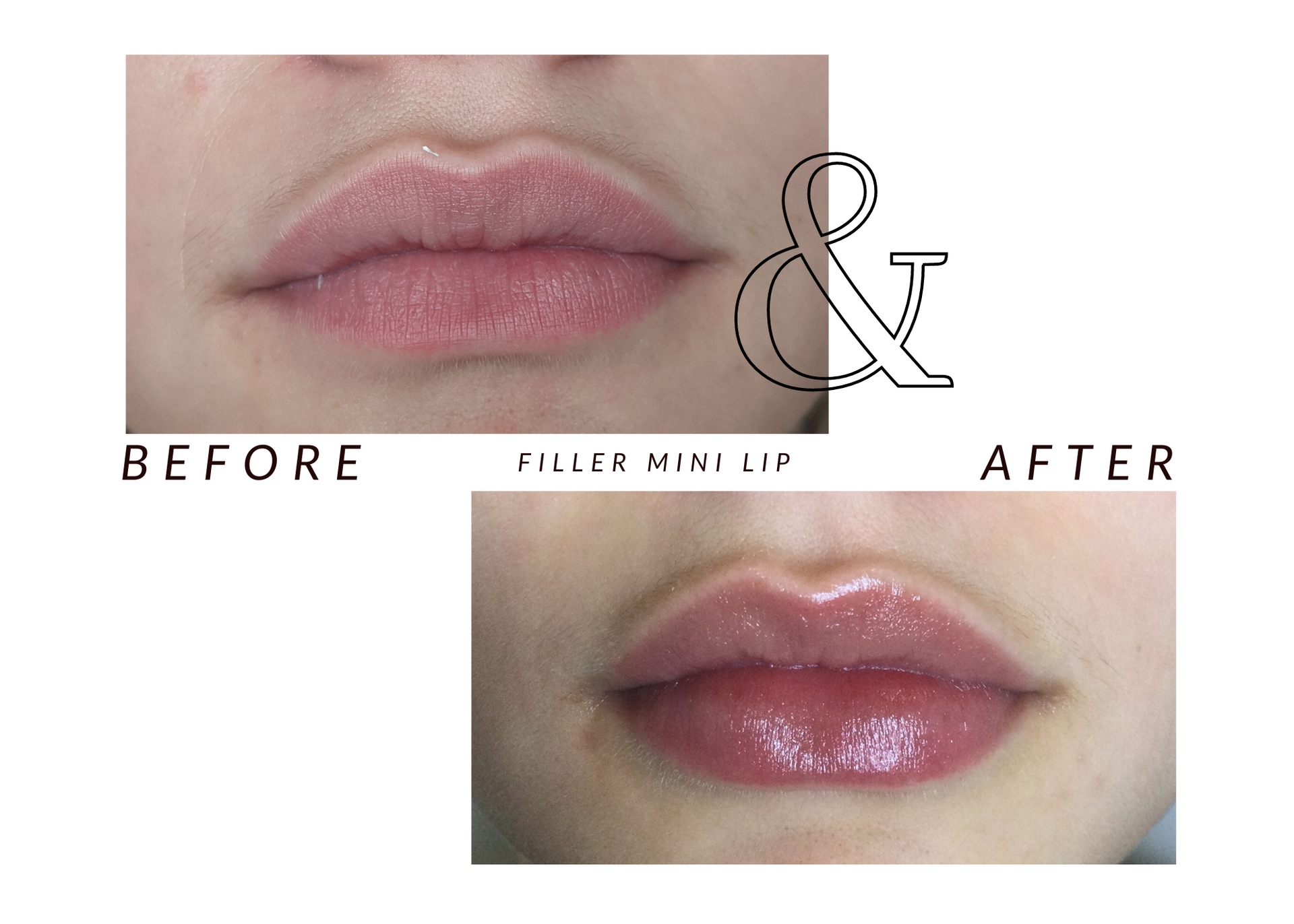 A picture of a woman 's lips before and after filler full lip enlargement