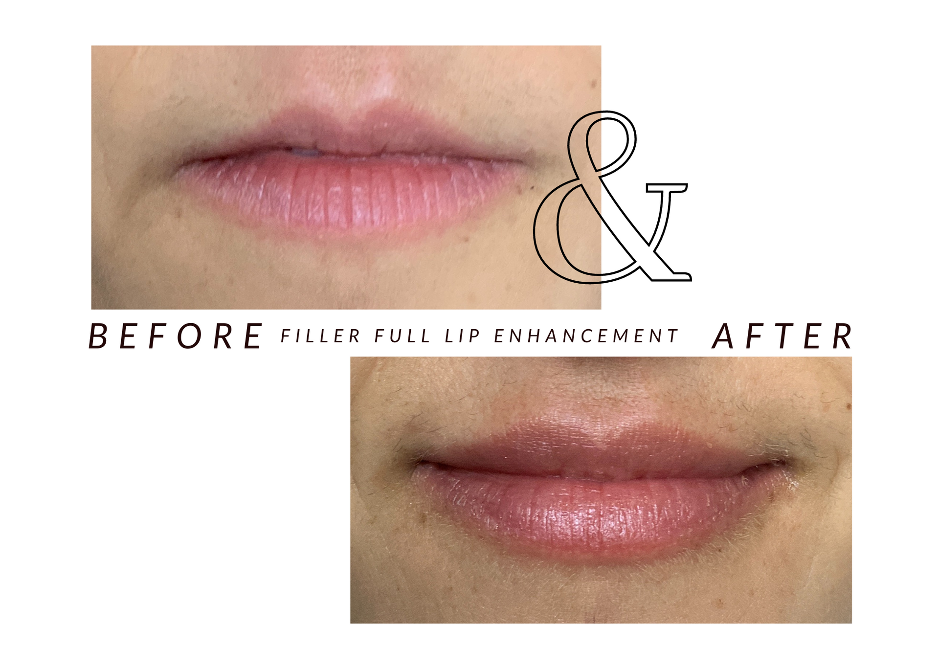 A picture of a woman 's lips before and after filler full lip enlargement