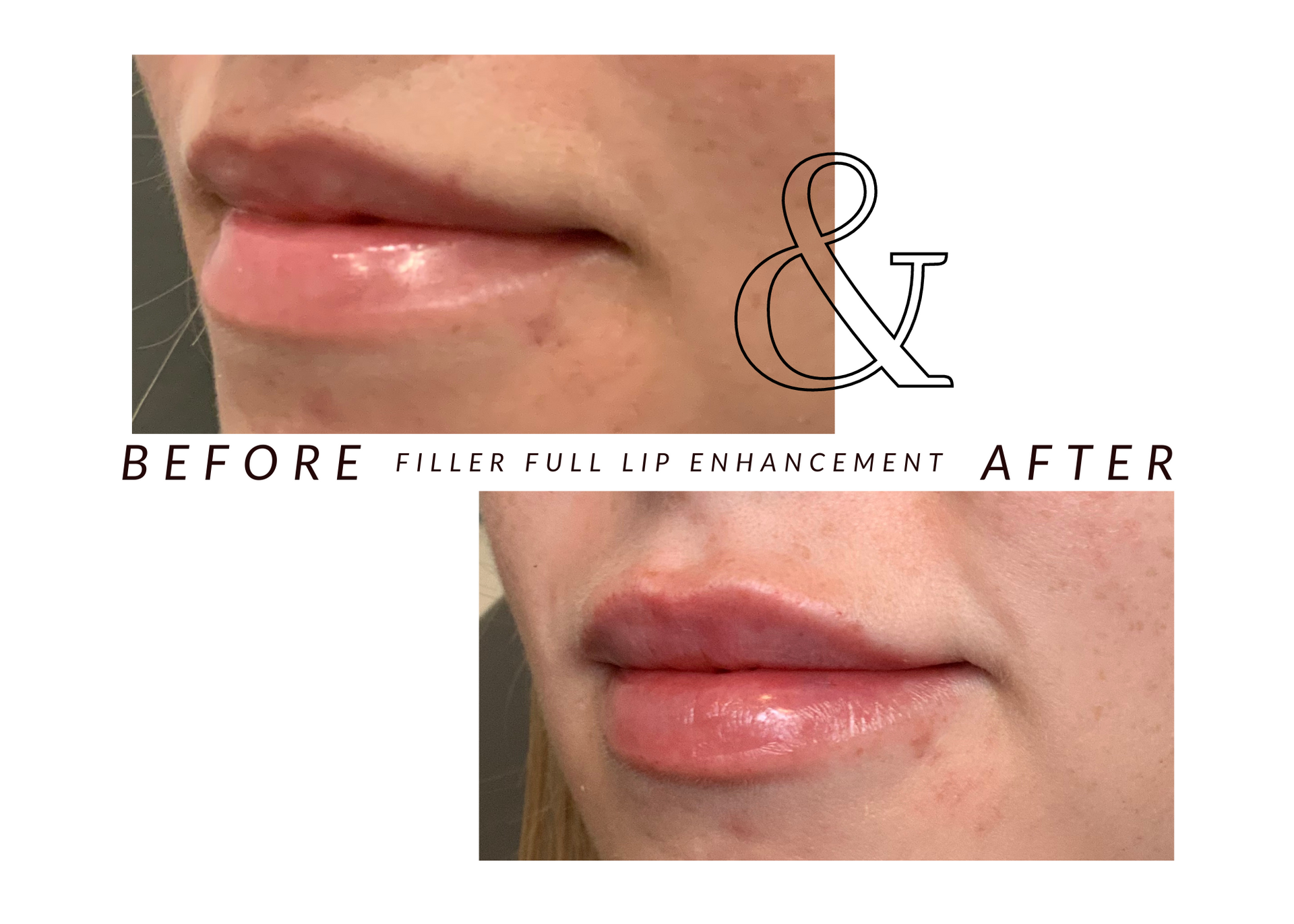 A picture of a woman 's lips before and after filler full lip enlargement