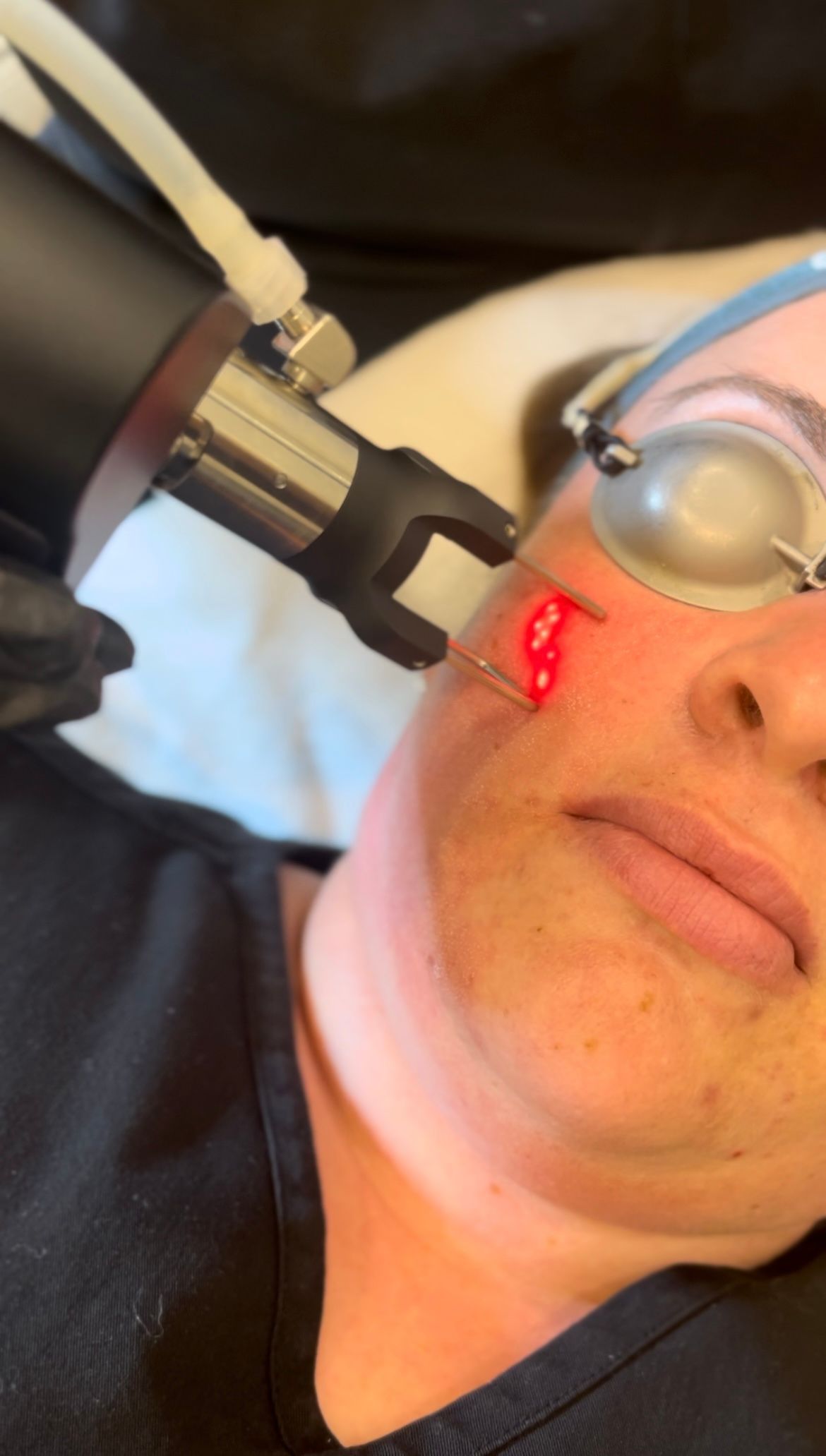 A woman is getting a laser treatment on her face