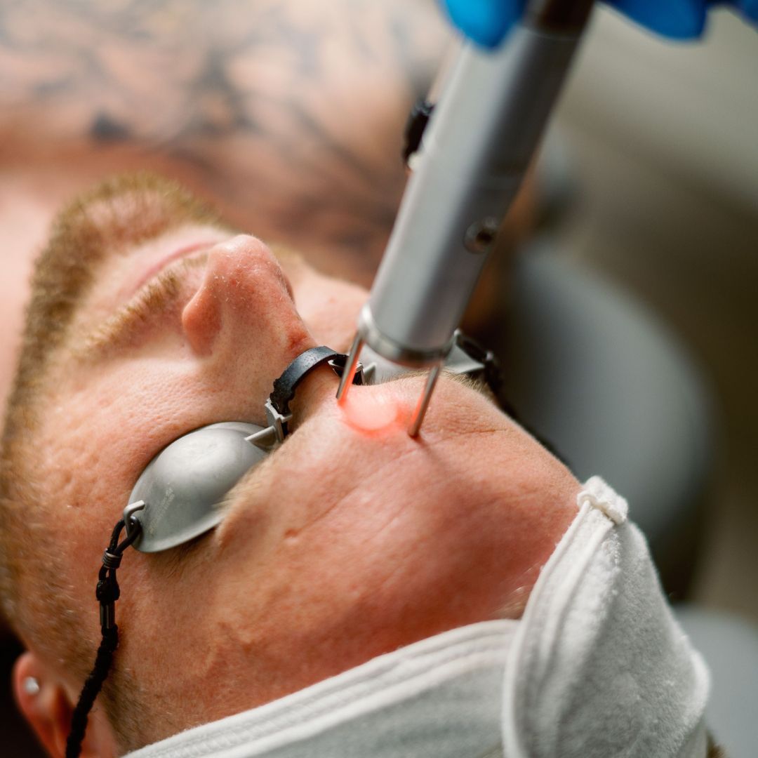 Close-up of laser eye treatment on a patient wearing protective goggles.